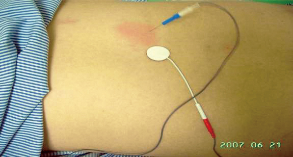 針極肌肉內電刺激治療NEIMStim02